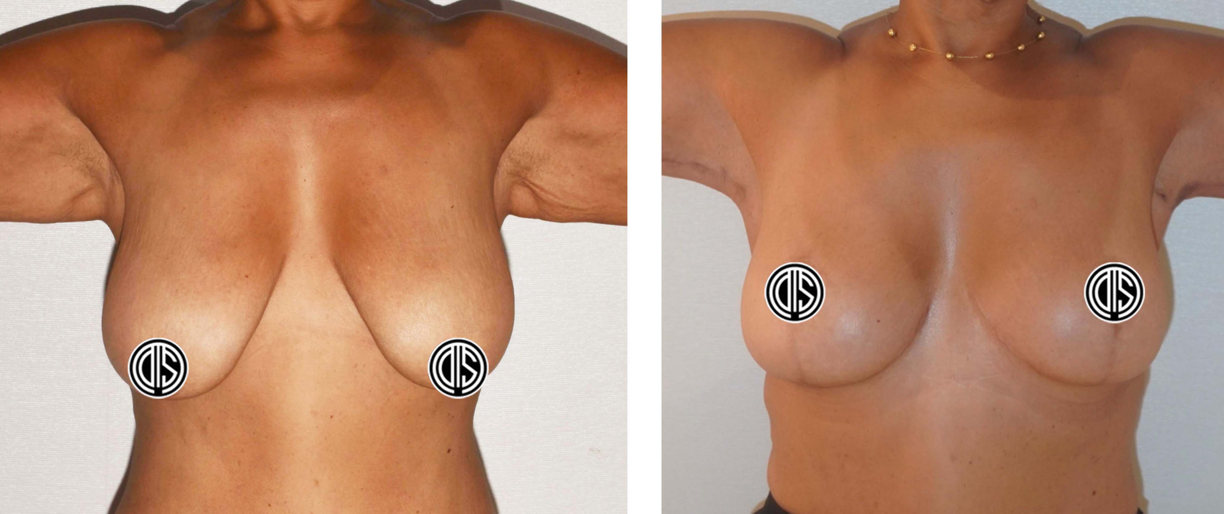 Breast reduction case 1, before surgery on the left and after surgery on the right